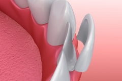Porcelain Dental Veneers | Buffalo Depew NY | Dr Evola