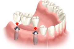 pont.sur_.implant